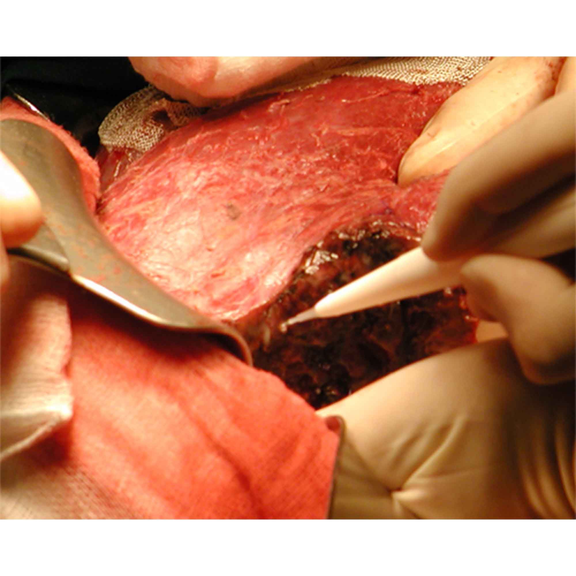 Close-up of gloved hands and instruments during a surgical procedure