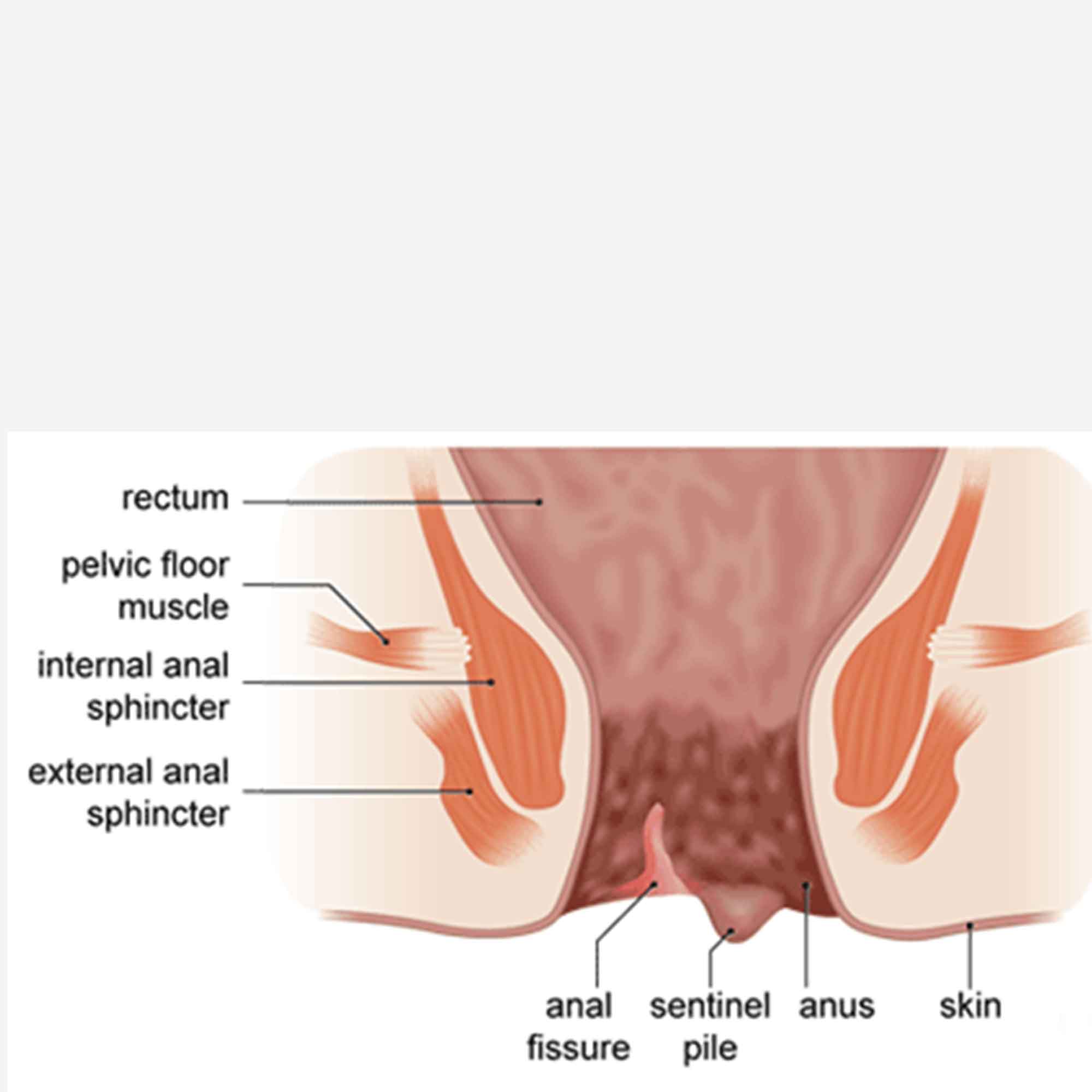 Labelled illustration of an anal fissure and surrounding anatomy