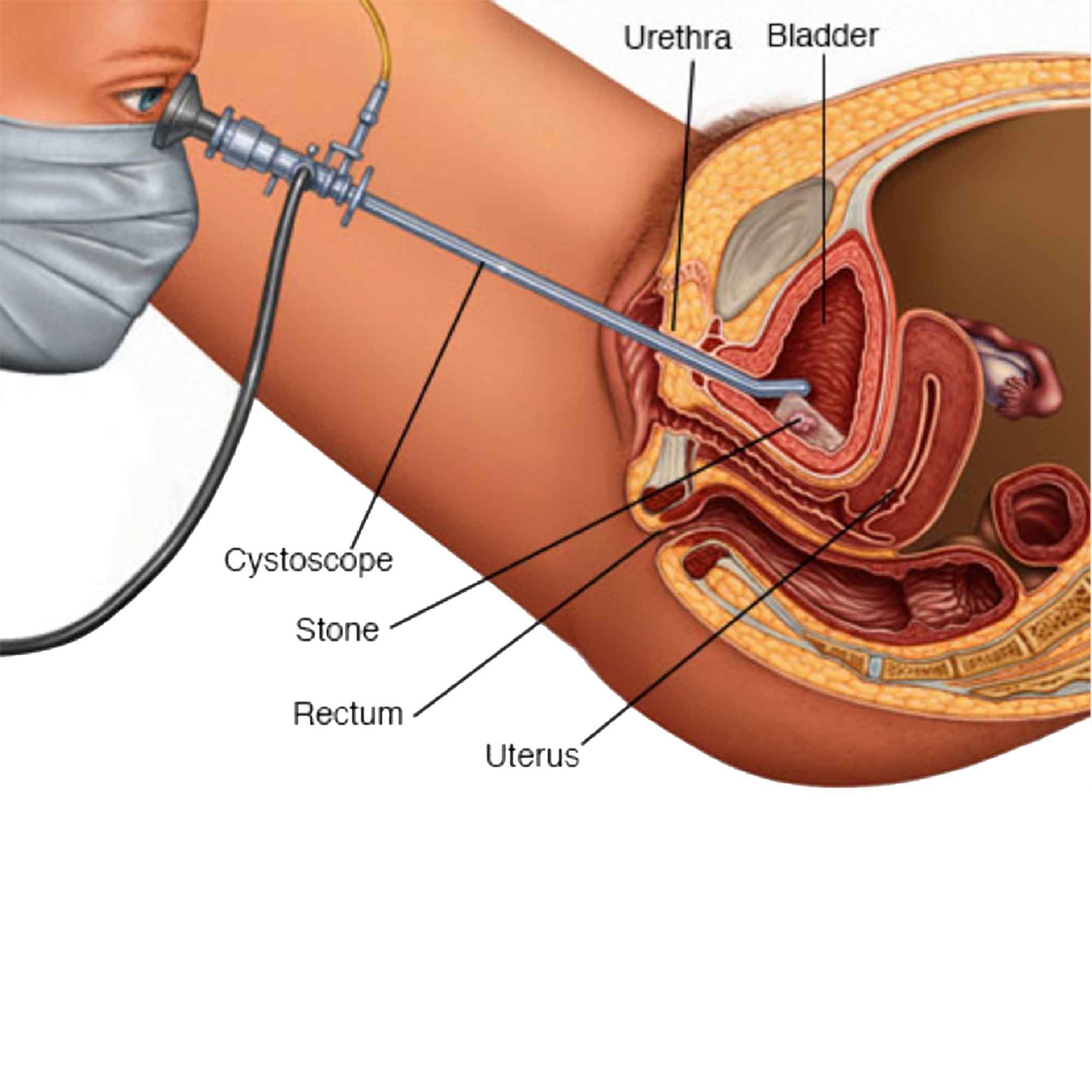 Labelled diagram of a cystoscope entering the bladder through the urethra