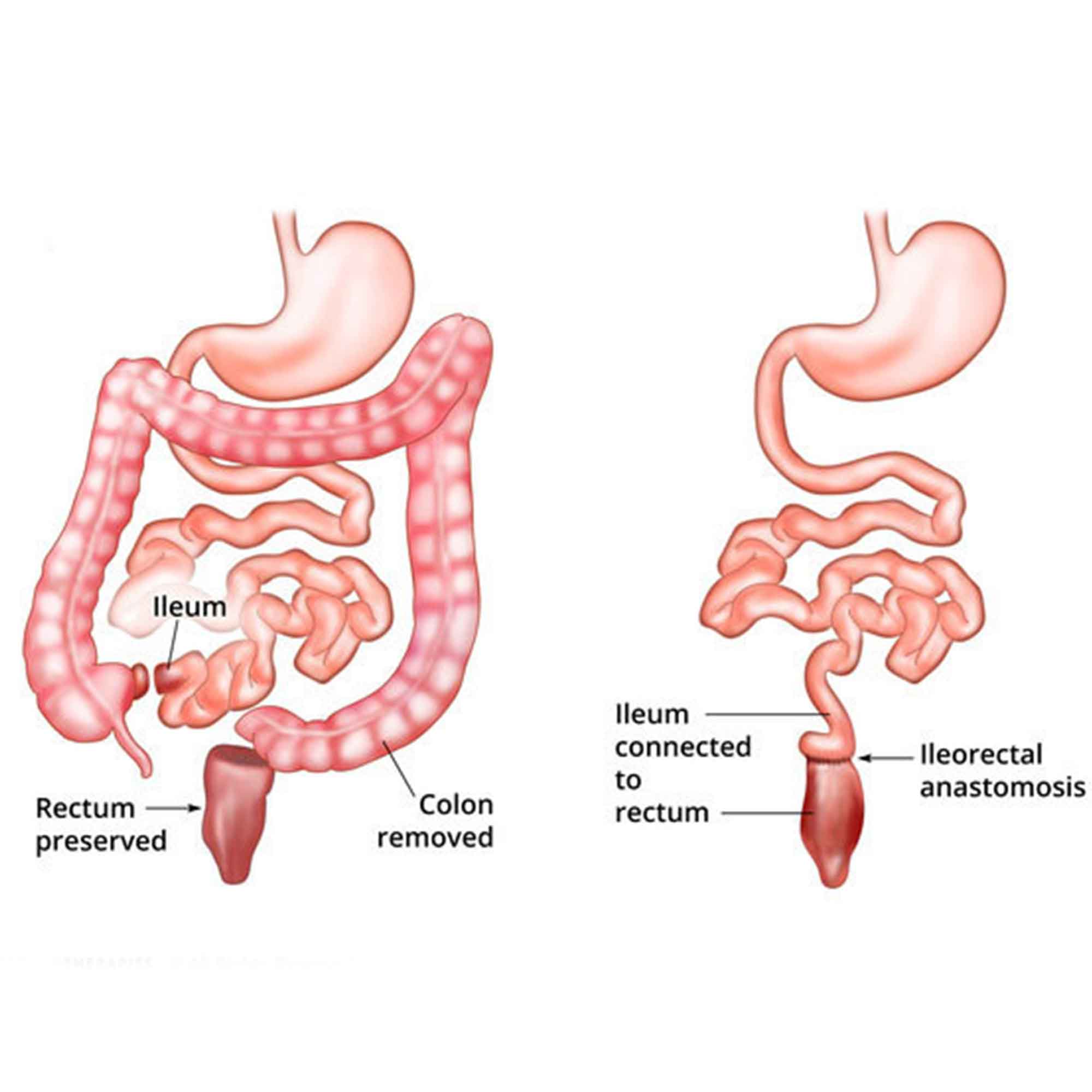 Paired diagrams of the digestive tract before and after removal of the colon