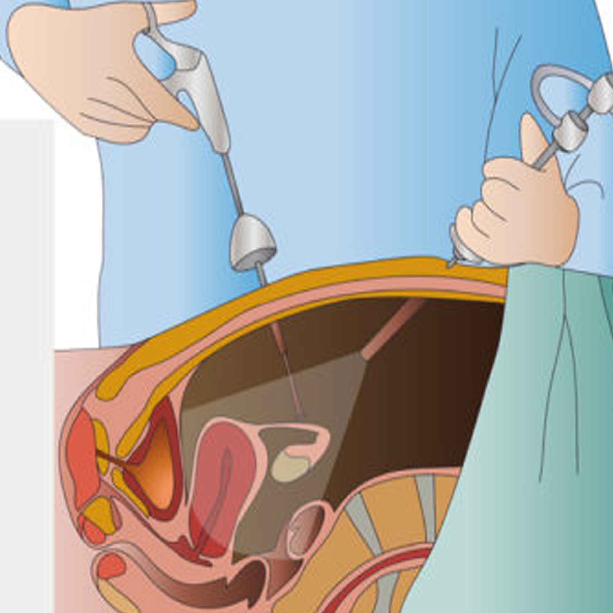 Illustration of surgical instruments entering the abdomen through small openings