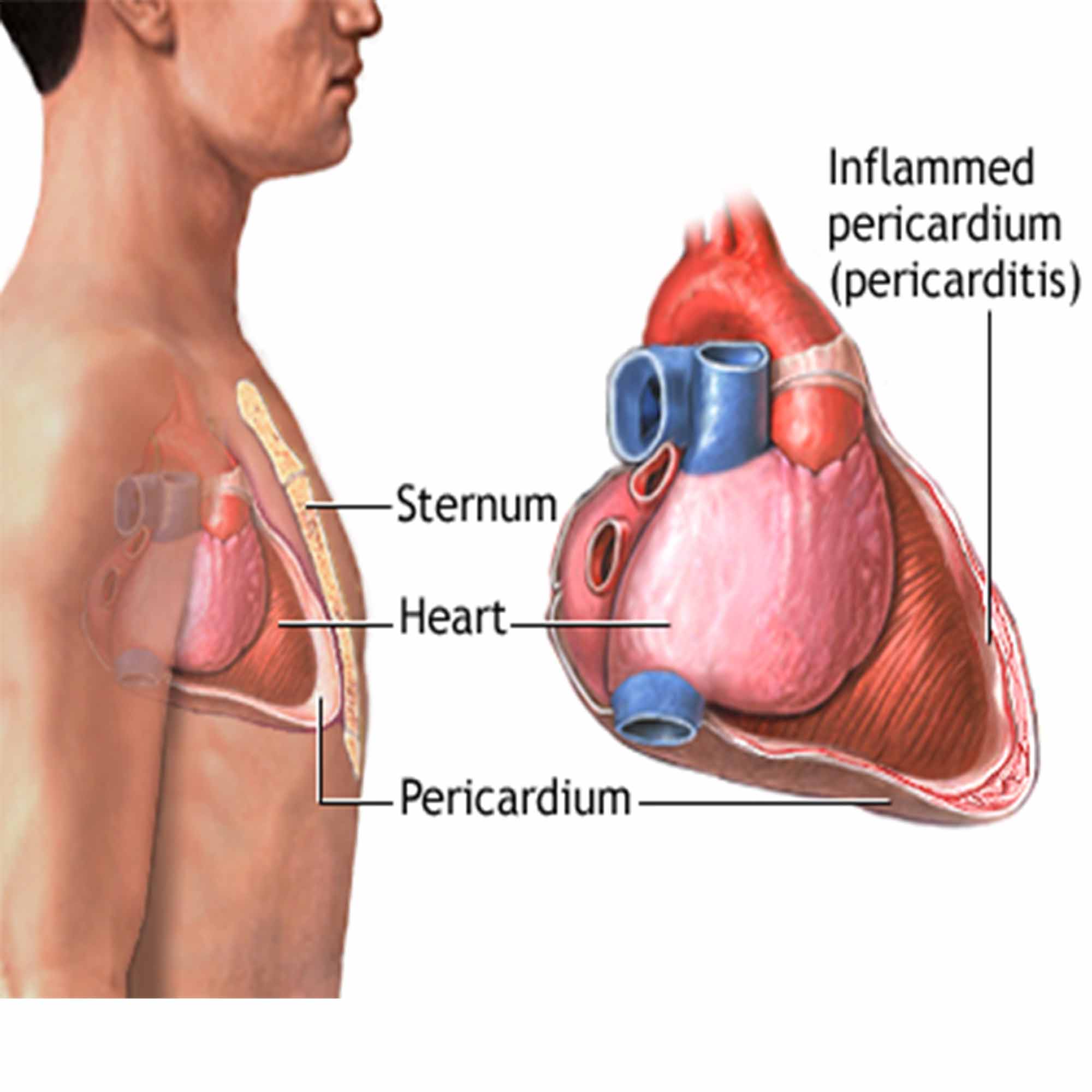 Medical diagram showing the heart and an inflamed pericardium