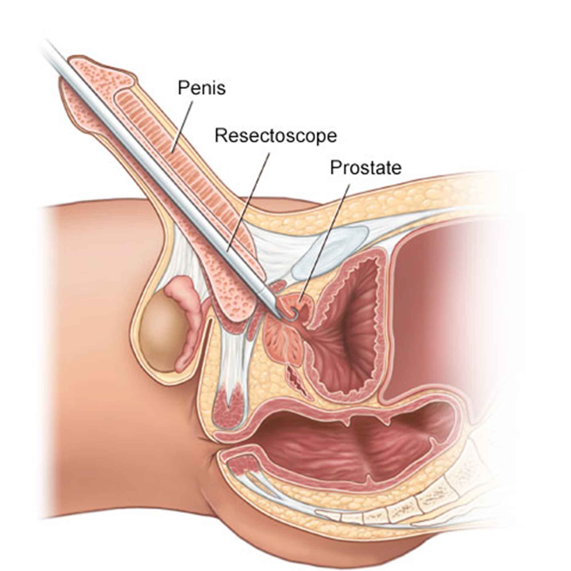 Diagram of a resectoscope passing through the urethra to the prostate