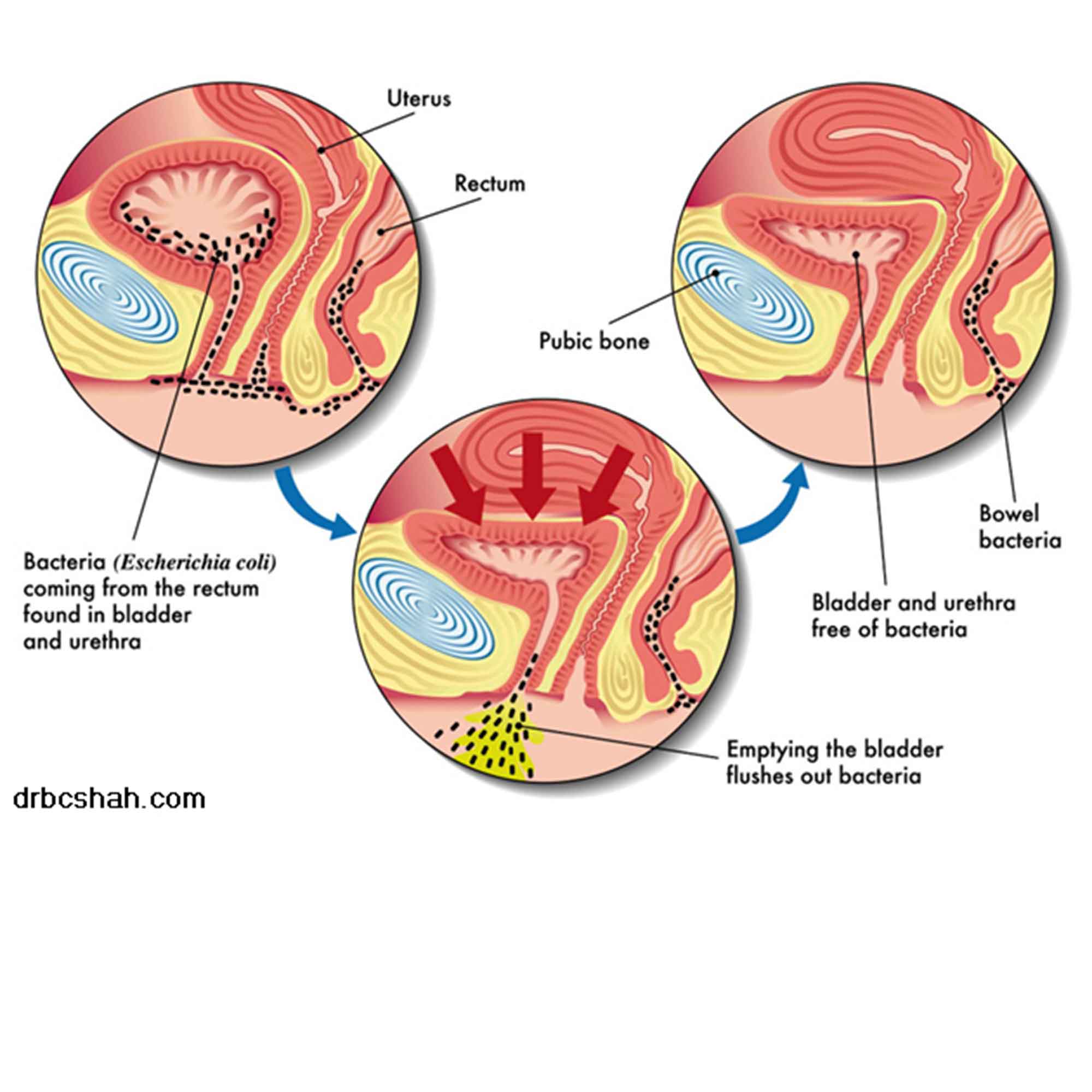 Diagrams of the female urinary tract illustrating the spread of bacteria to the bladder