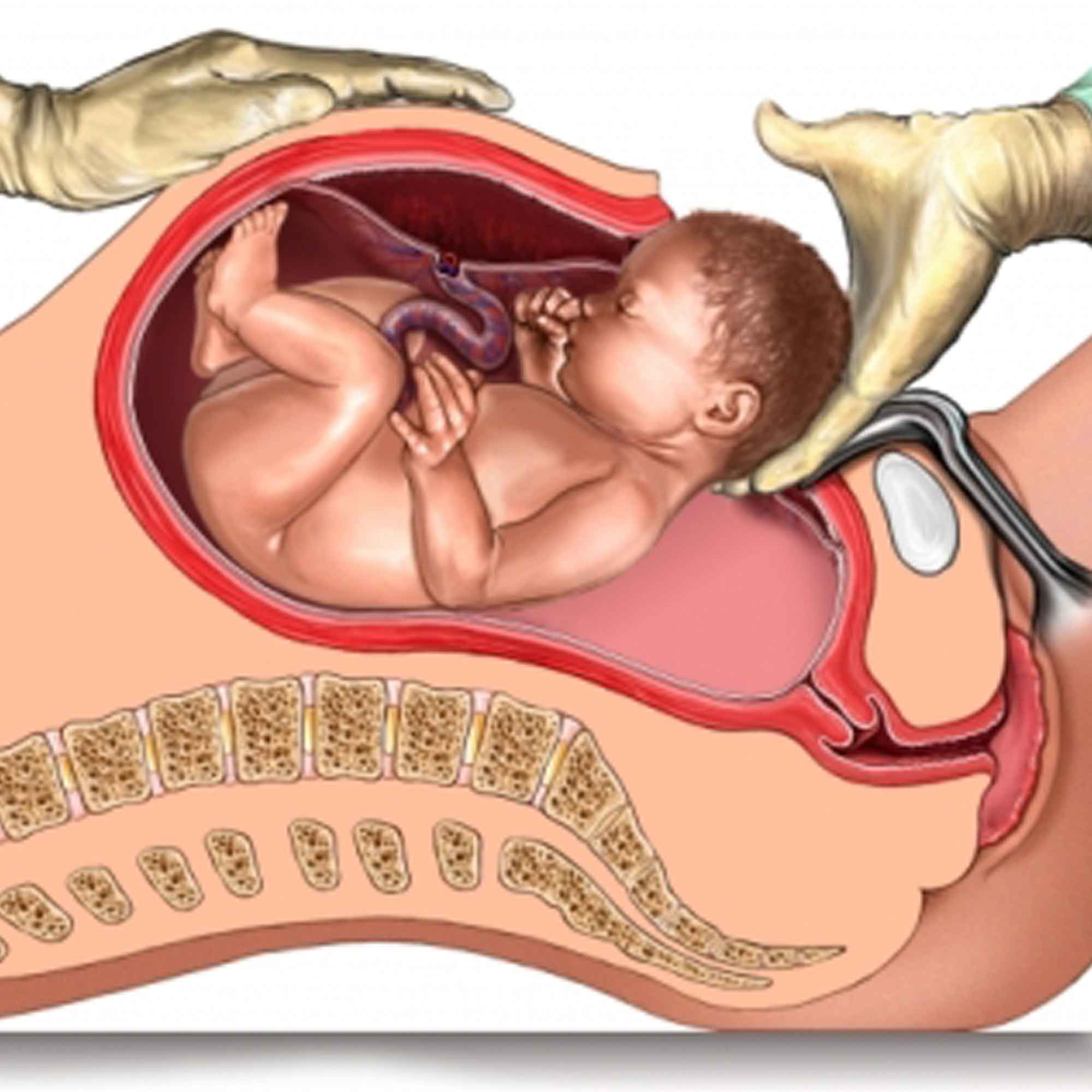 Cross-sectional illustration of a baby being delivered by caesarean section