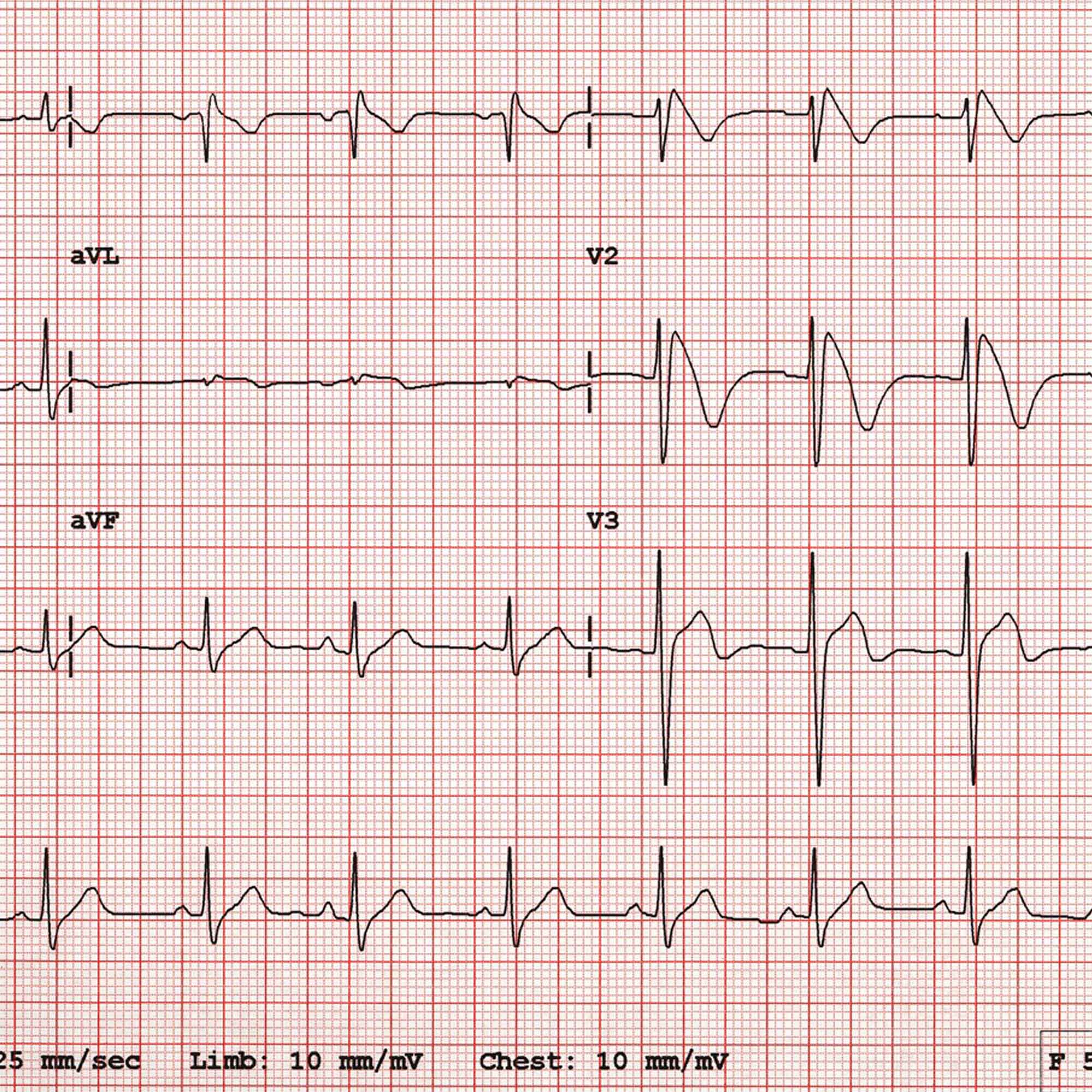 Multiple ECG waveforms printed on graph paper